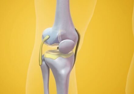 Knee Replacement Surgery Cost in India 2026